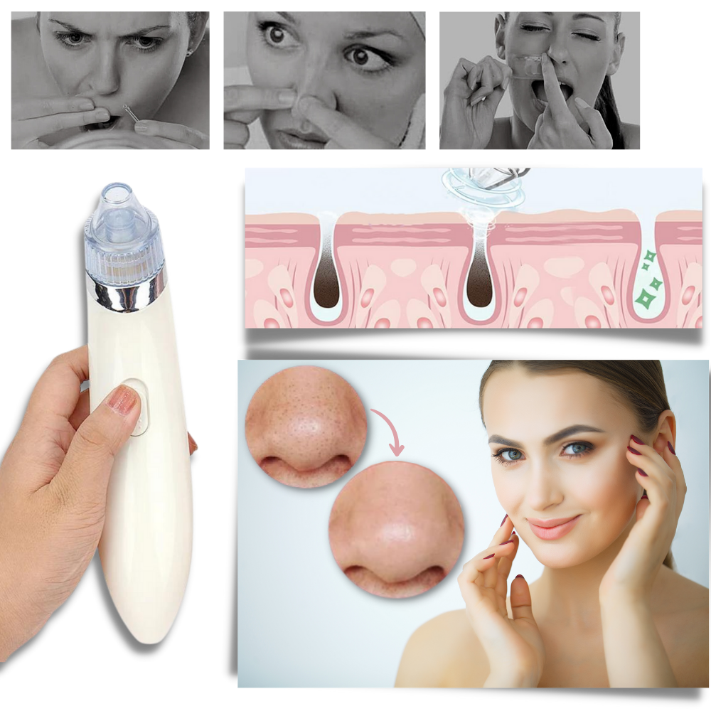 Aspirador de pontos negros da Akloker, dispositivo de limpeza facial com design rosa para remover cravos e impurezas da pele.
