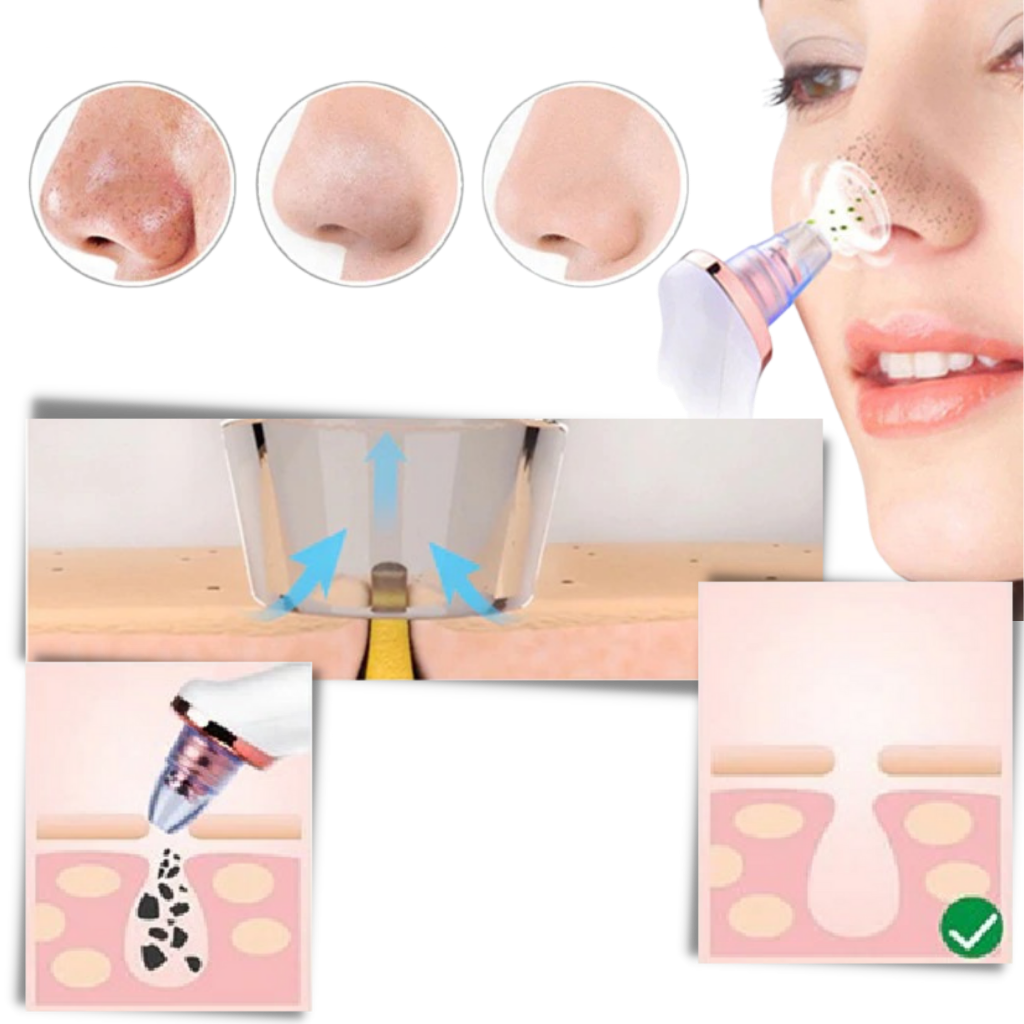 Aspirador extracteur de points negros da Asupermall, produto de cosméticos para limpeza facial.