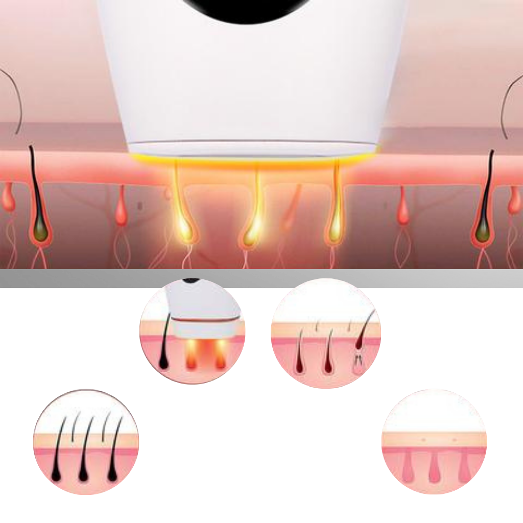 Dispositivo de depilação a laser IPL da marca Genérico, para remoção de pelos com tecnologia de luz pulsada.