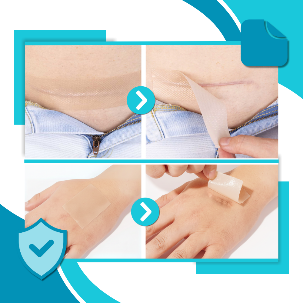 Adesivo de silicone com ácido hialurônico para cicatrizes, produto de primeiros socorros da marca Dongzhur, removido limpo e sem sujeira.
