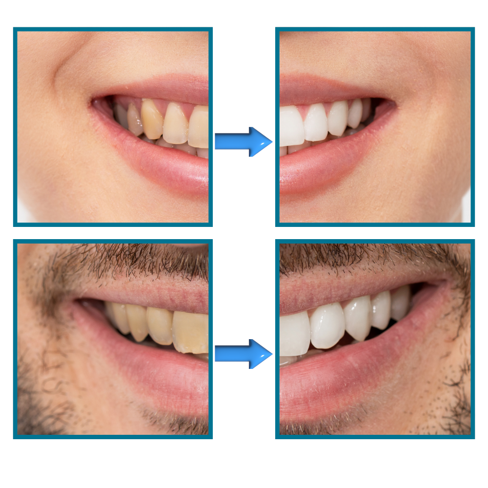 Dentifrice blanchisseur de dents Kdqueery pour soins buccaux, elimine rapidement les taches et blanchit les dents, saveur fruit de la passion
