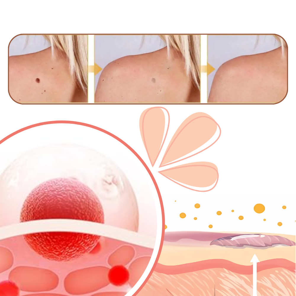 Tratamento não invasivo de excrescências com cosméticos Lin Chow, produto de cuidados para a pele natural e eficaz.