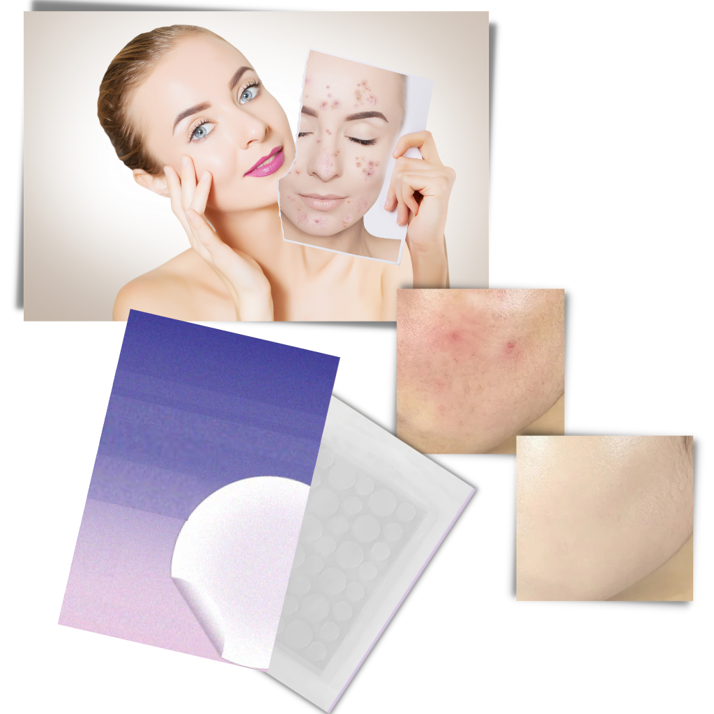 Pack de 36 patches invisíveis contra acne, produto de cuidados cosméticos para mulheres, visíveis na imagem