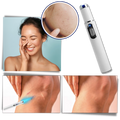 Caneta laser azul para eliminação de manchas, produto cosmético da marca Smallbee, com apontador e detalhes visíveis.