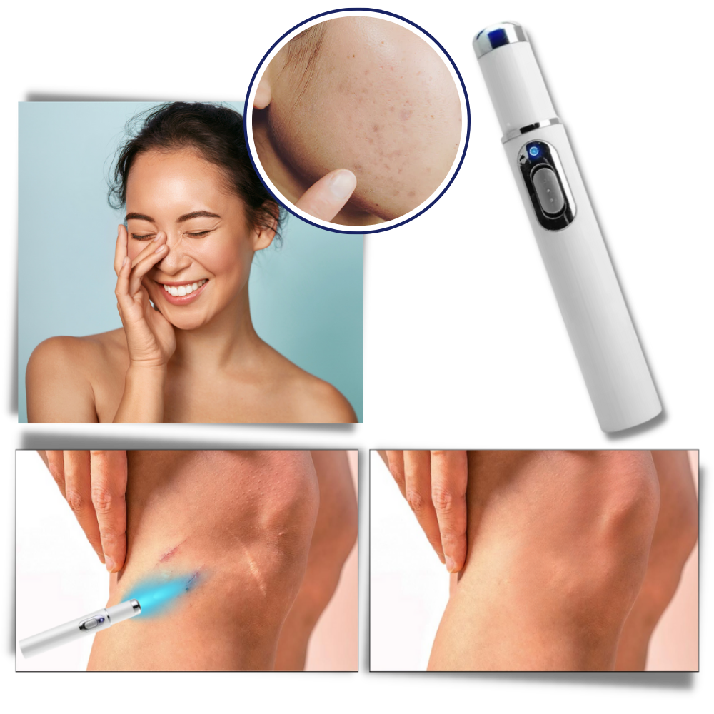 Caneta laser azul para eliminação de manchas, produto cosmético da marca Smallbee, com apontador e detalhes visíveis.