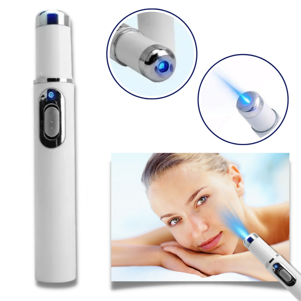 Caneta a laser azul da Smallbee para eliminação de manchas, mostrada com design portátil e acabamento compacto.