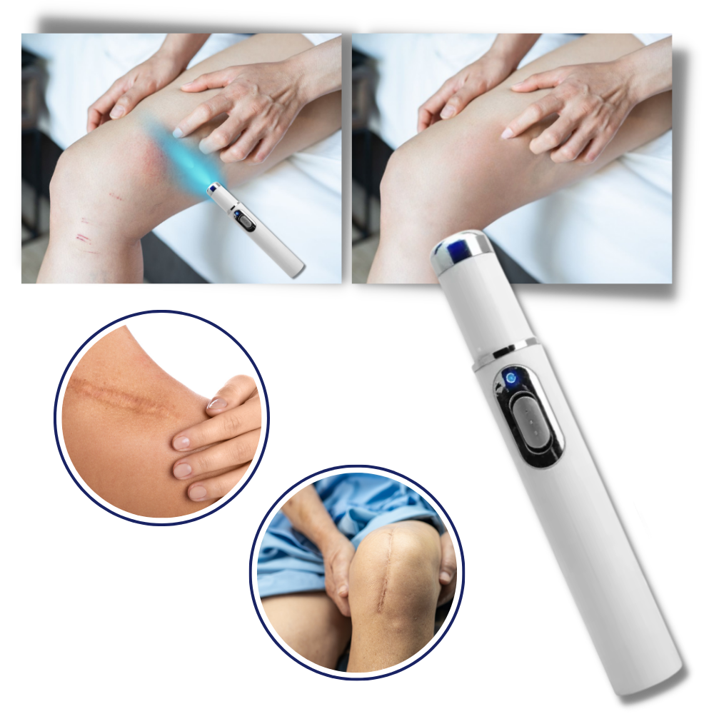 Caneta laser azul para eliminação de manchas, produto cosmético Smallbee, mostrando o dispositivo portátil.