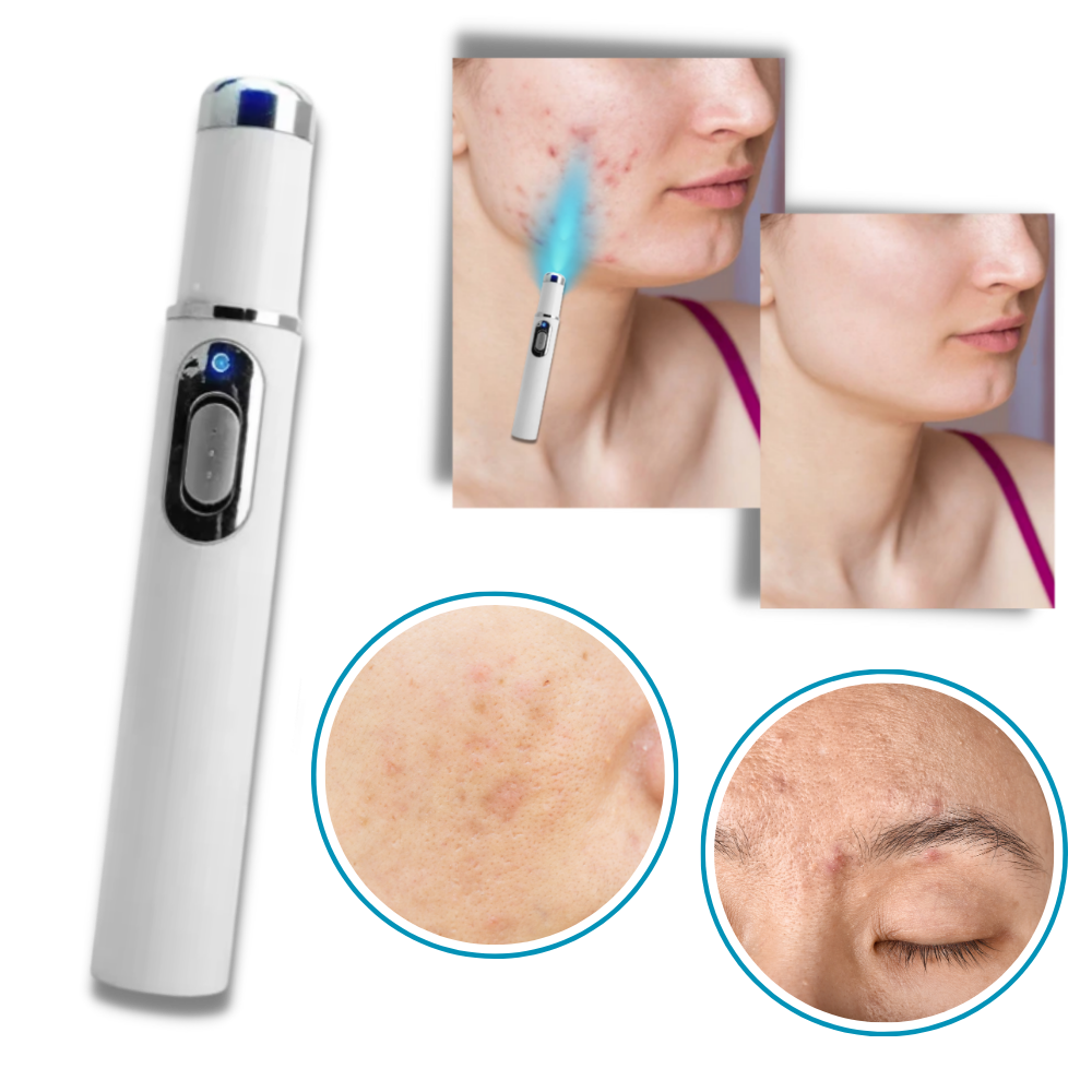 Caneta laser azul da Smallbee para eliminação de manchas, com design compacto e ponta de aplicação visível.