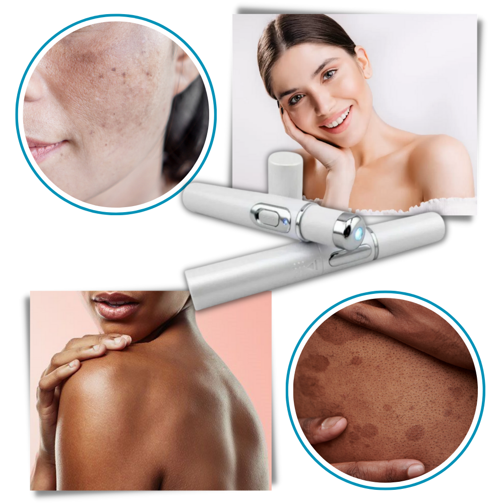 Caneta a laser azul da Smallbee para eliminação de manchas, mostrando a ponta e o corpo do produto cosmético.