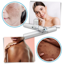 Caneta a laser azul da Smallbee para eliminação de manchas, mostrando a ponta e o corpo do produto cosmético.