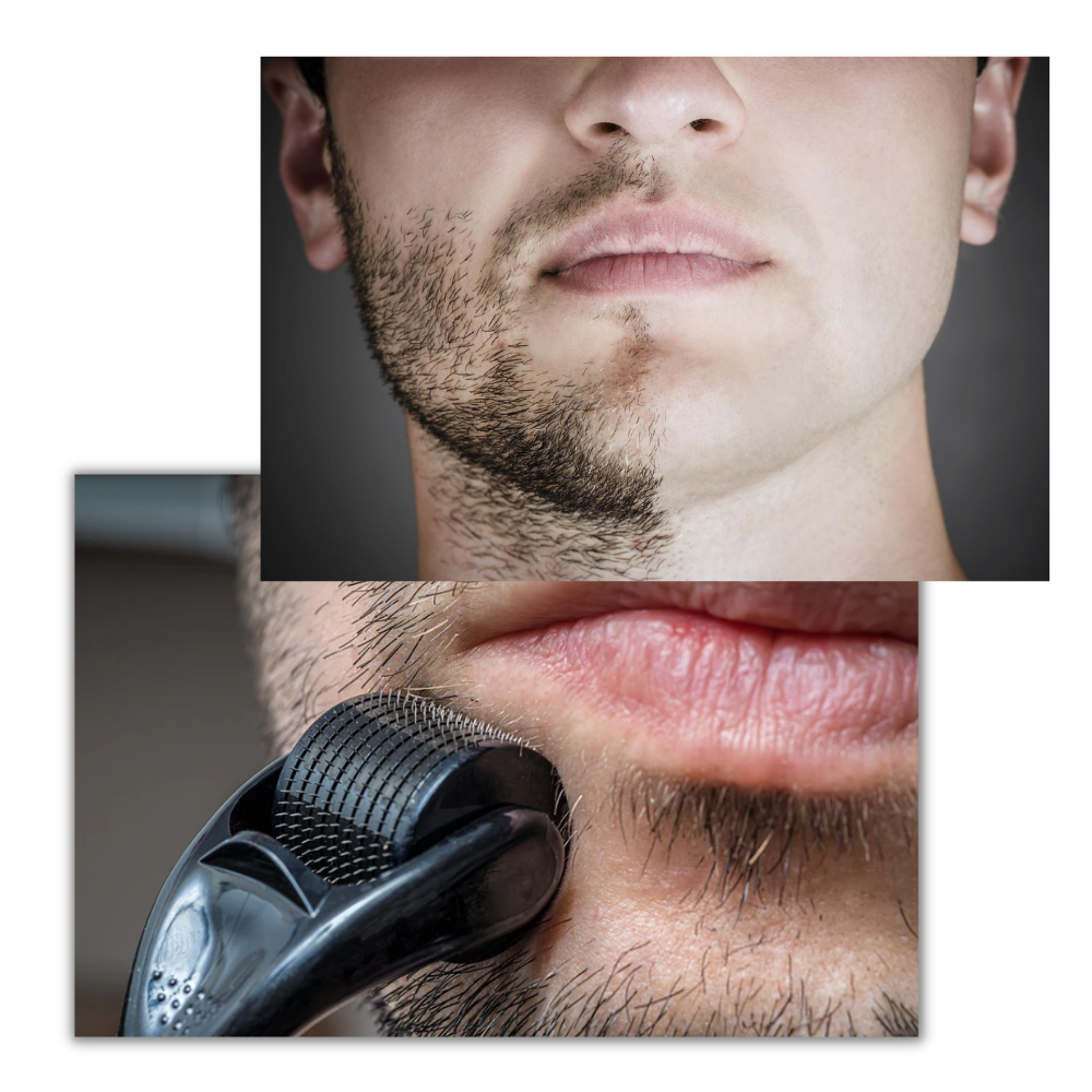 Rouleau dermique preto da Valy Layton para cuidados capilares e crescimento de cabelo e barba, com textura suave e detalhe visível