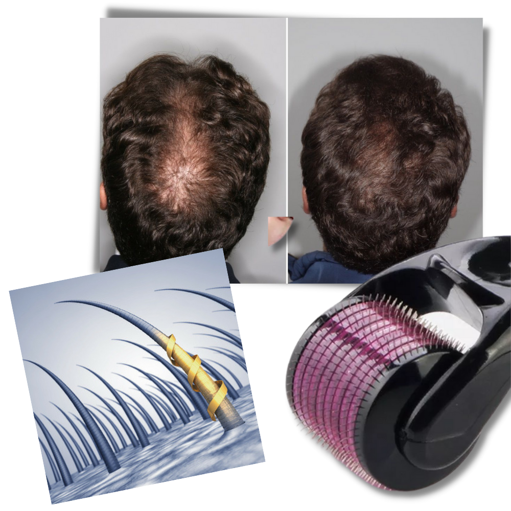 Rouleau dermique preto para crescimento de cabelo e barba, produto de cuidado capilar da marca Valy Layton, uso para estimular cabelos.