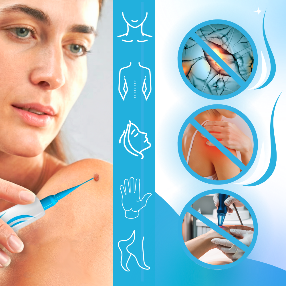 Kit de tratamento profissional de acrochordons Zerone, cosméticos para remoção de verrugas e lesões cutâneas.