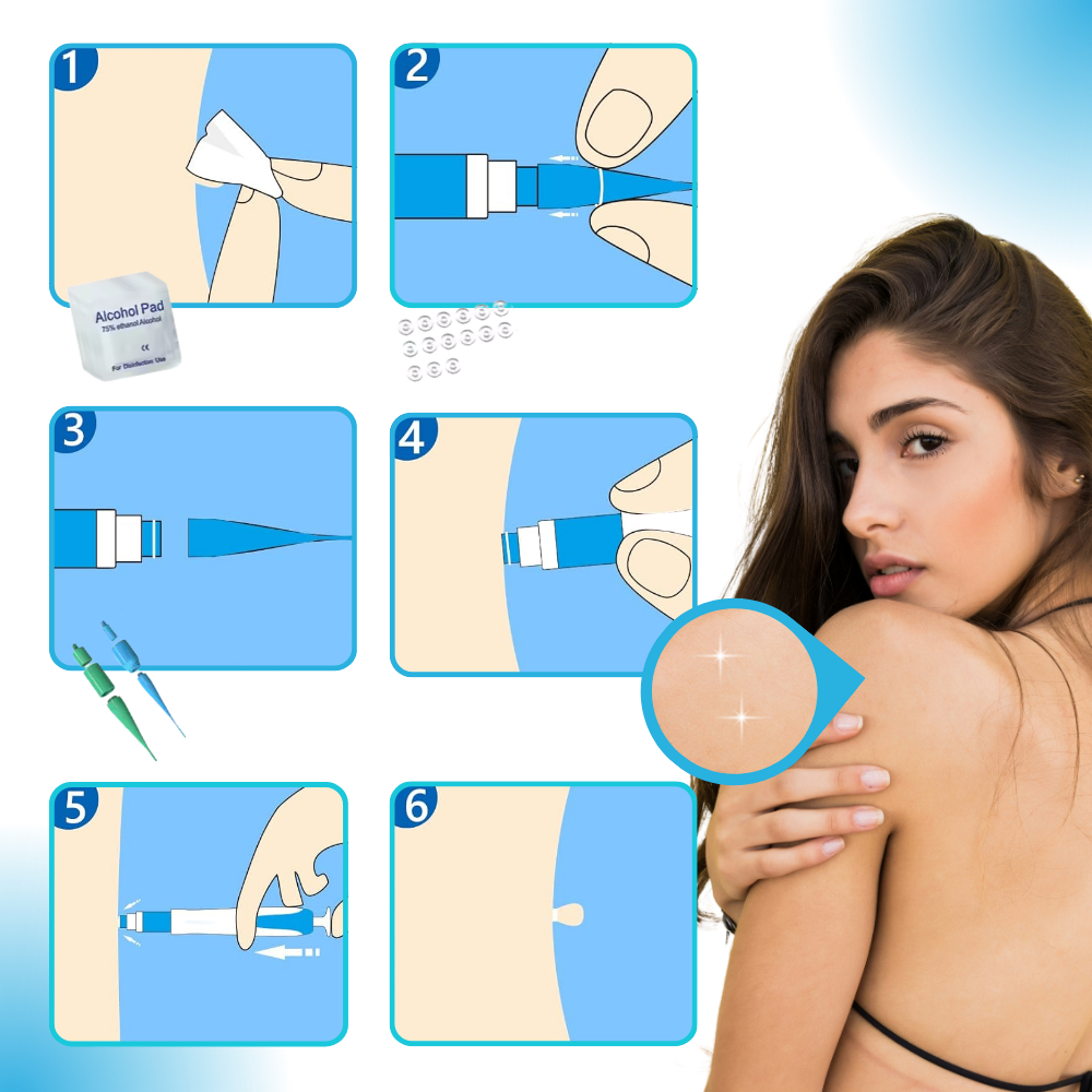 Kit de tratamento profissional Zerone para acrochordons, com produtos cosméticos para remoção segura de verrugas e lesões cutâneas